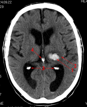 Cerebral Bl Dning Thalamus Ct L Geh Ndbogen P Sundhed Dk