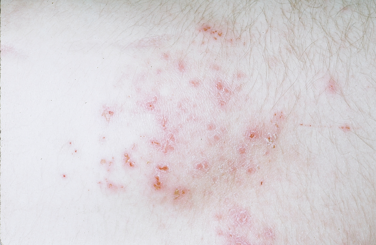 Dermatitis Herpetiformis L Geh Ndbogen P Sundhed Dk