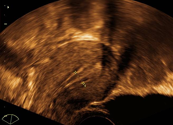 Livmoder, Normal, Ultralyd - Lægehåndbogen På Sundhed.dk