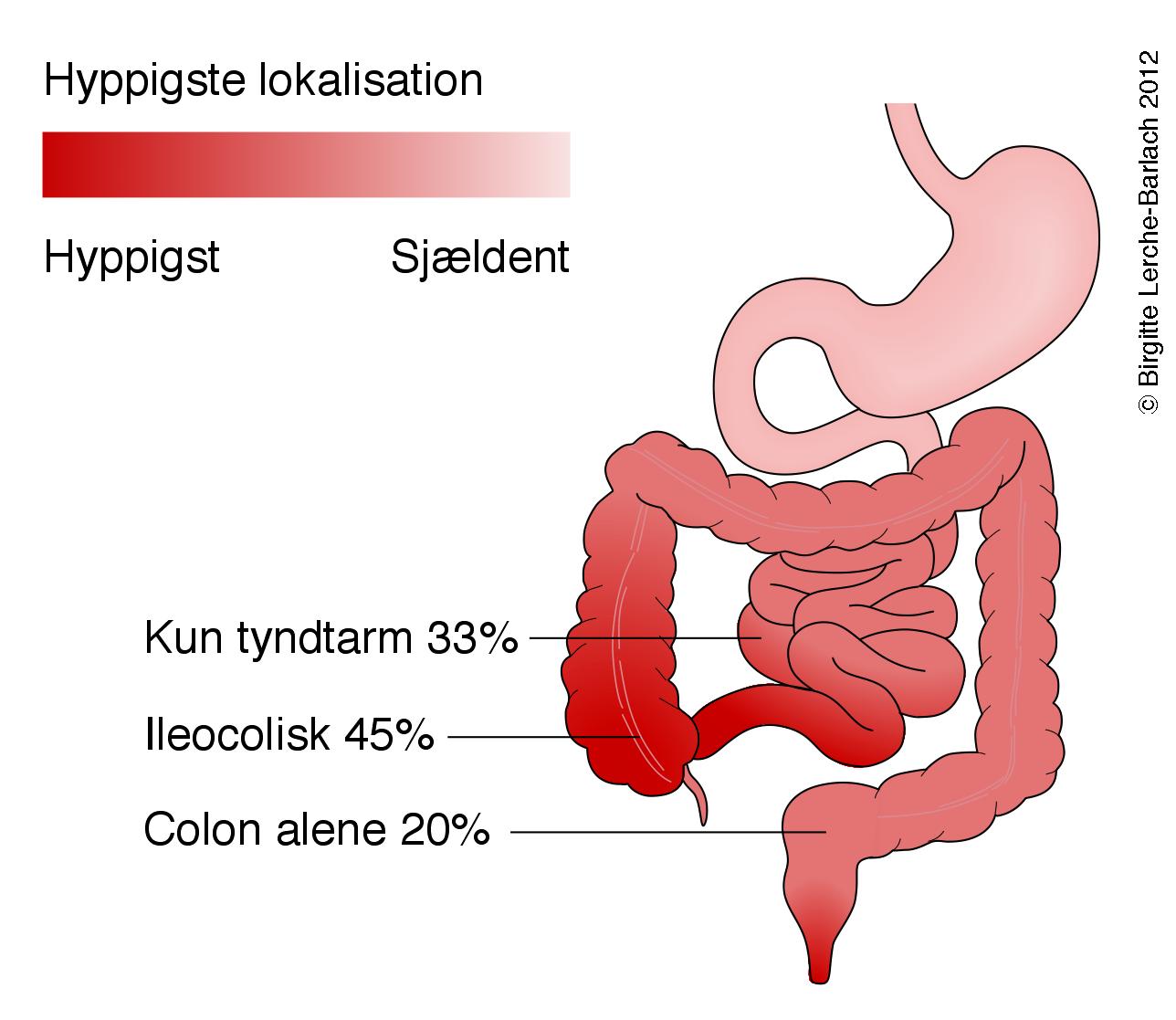 Crohns sygdom anatomisk fordeling Lægehåndbogen på sundhed dk