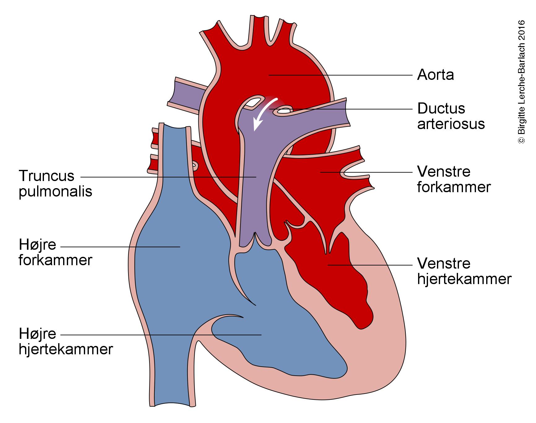 Persisterende ductus arteriosus - Patienthåndbogen på sundhed.dk