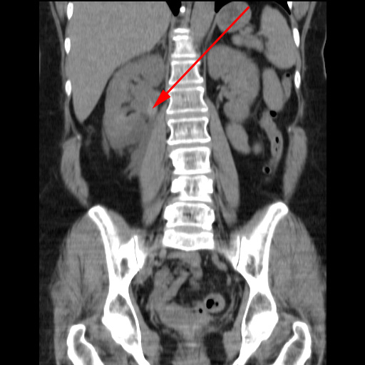 Nyre Malign Tumor Ct 1 Laegehandbogen Pa Sundhed Dk